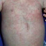 আজ থেকে শুরু হচ্ছে বিশেষ টিকাদান : লক্ষ্যমাত্রা ৬০ হাজার শিশু