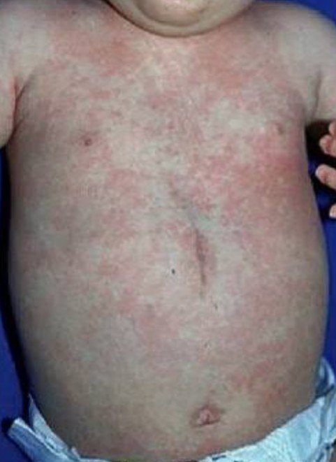 আজ থেকে শুরু হচ্ছে বিশেষ টিকাদান : লক্ষ্যমাত্রা ৬০ হাজার শিশু