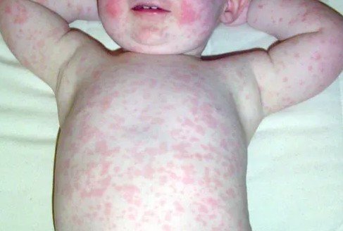 সন্দেহজনক আরও ৪মৃত্যু ও নতুন আক্রান্তের খবরে উদ্বেগ